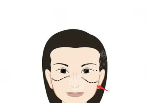 颧骨高有什么办法改良