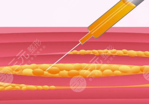 苹果肌凹陷怎么改良