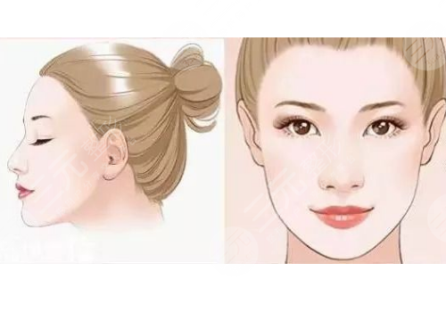 苹果肌凹陷怎么改良