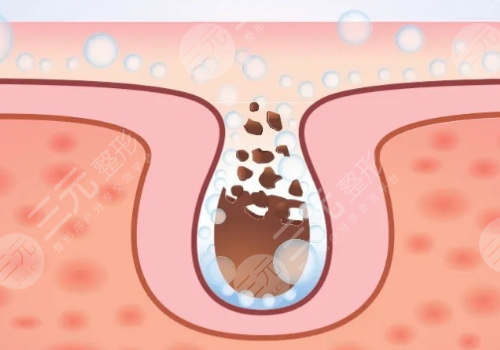 面颊毛孔粗大怎么办？