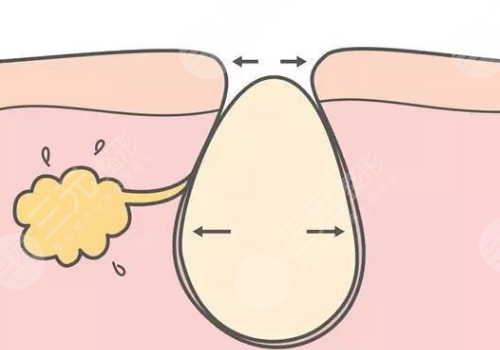 面颊毛孔粗大,怎么办