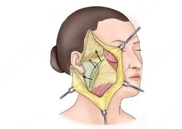 黄广香医生拉皮手术案例
