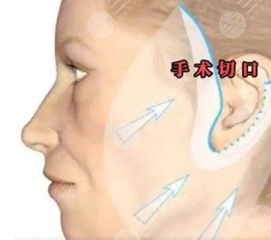 李晓东拉皮手术案例