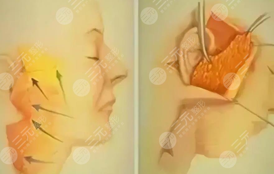 李晓东拉皮手术案例