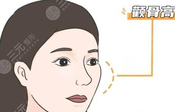 颧骨整形