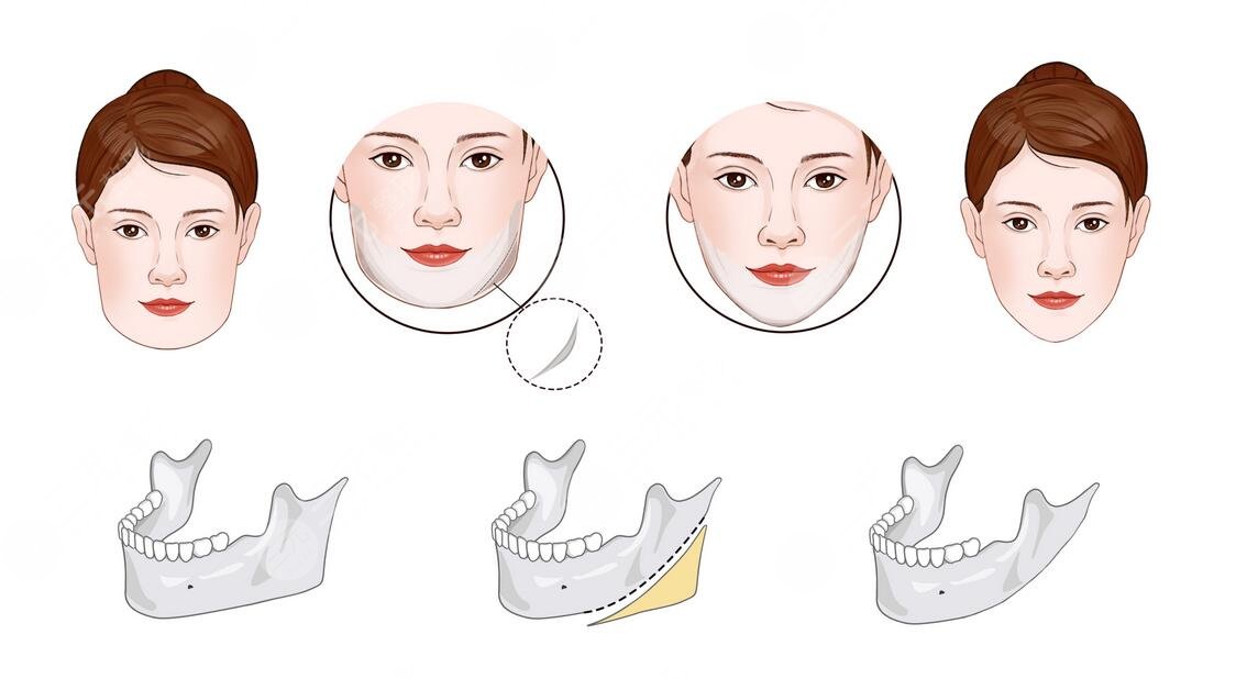 下颌角宽大怎么改良?
