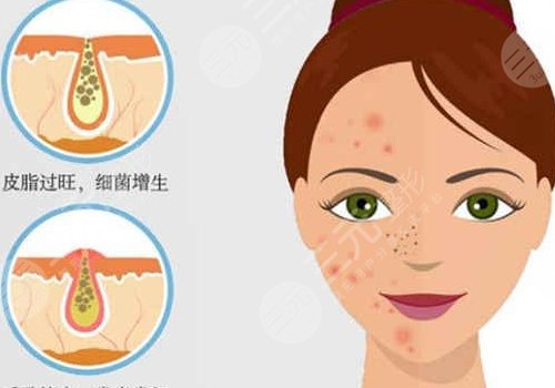 t区反复长痘痘的原因是什么？