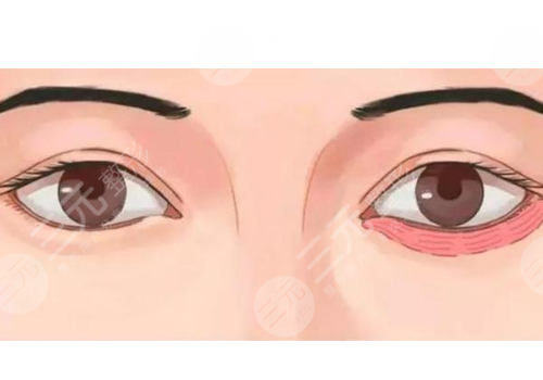 卧蚕填充用什么填好？