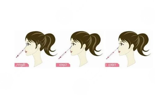 宝尼达隆鼻可以维持多久?