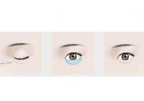 卧蚕填充需要多少钱