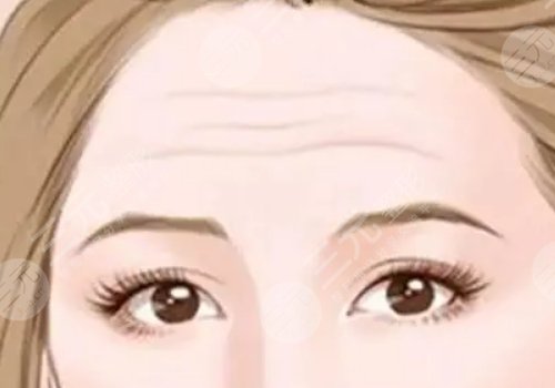 抬头纹去除手术需要多少钱?