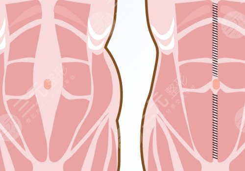 腹部拉皮手术多久能恢复正常？