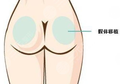 假体丰臀需要多少钱？