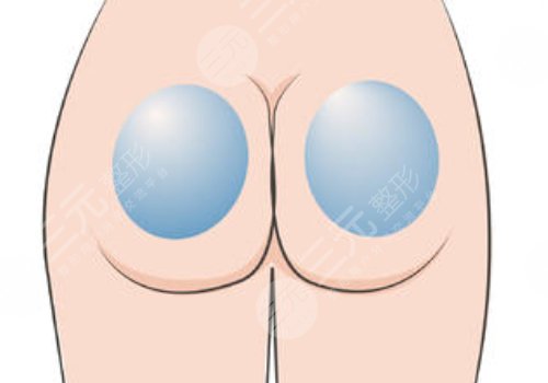 假体丰臀需要多少钱？