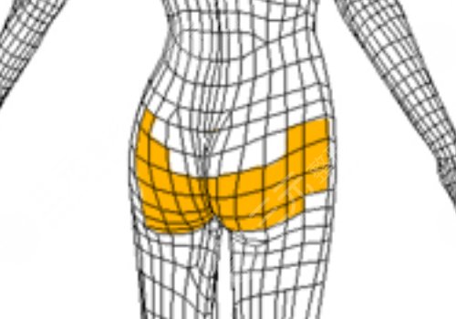 假体丰臀需要多少钱？