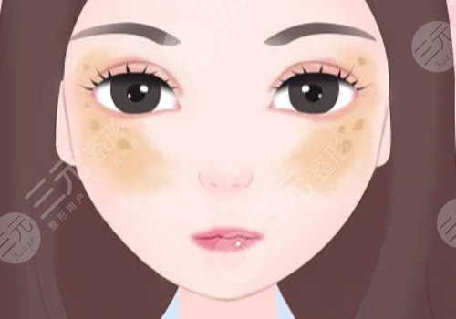 脸颊两侧长斑是什么原因？