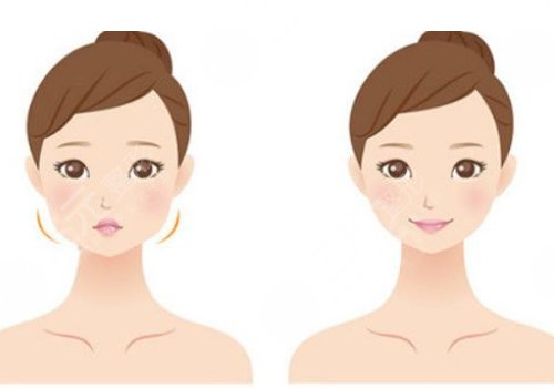 内轮廓固定提升能保持多久时间？