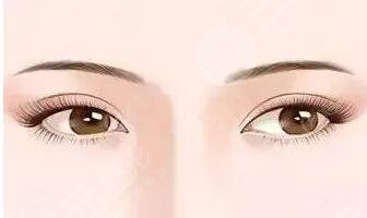 中国医学科学院整形科双眼皮案例