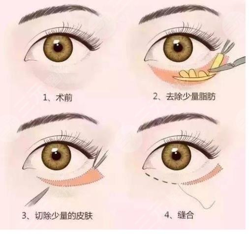 眼袋