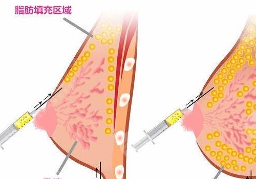胸型不好看可以调整吗？