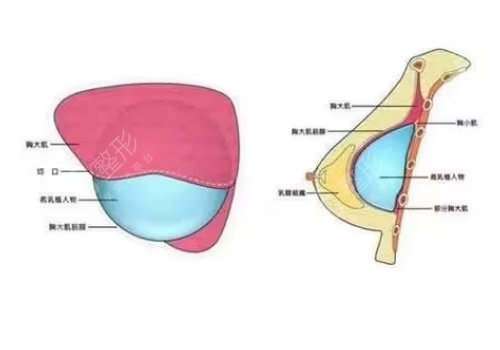 胸型不好看可以调整吗？