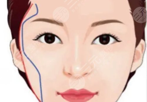 颧弓吸脂有什么后遗症？