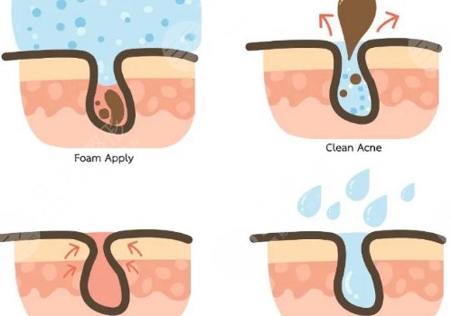 t区出油毛孔粗大怎么办？