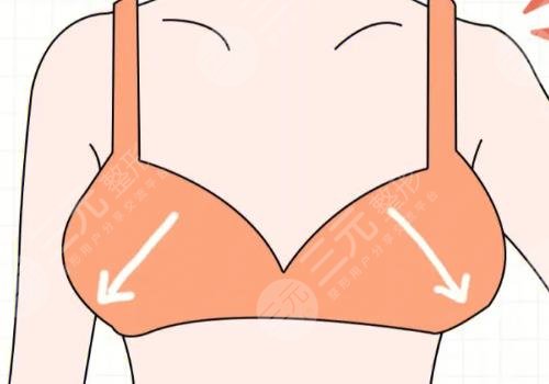 胸型外扩怎么矫正