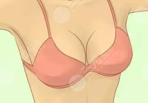 胸型外扩怎么矫正