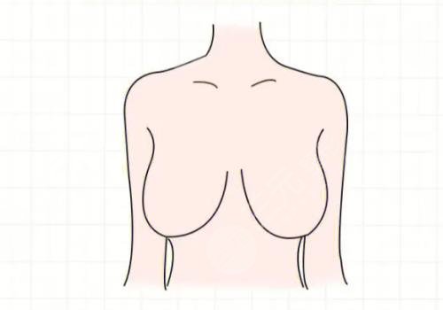 胸型外扩怎么矫正
