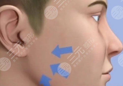 外轮廓固定提升有哪些手术方案？