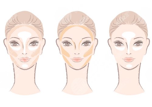 外轮廓固定提升有哪些手术方案？