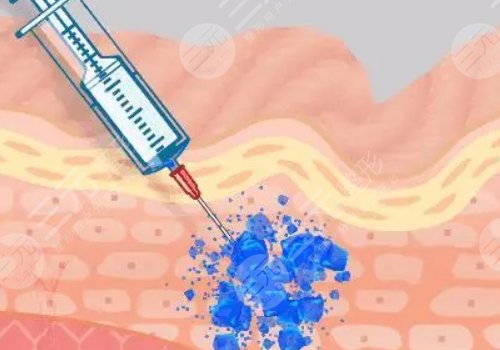外轮廓固定提升有哪些手术方案？