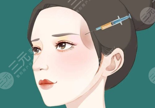 外轮廓提升需要几支玻尿酸？