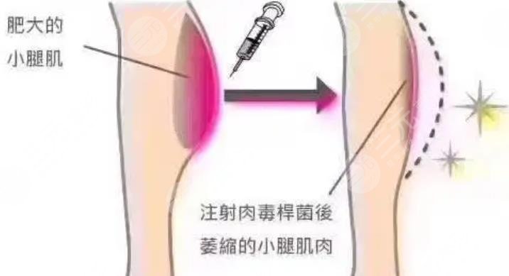 注射瘦腿
