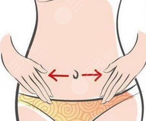 腰腹抽脂
