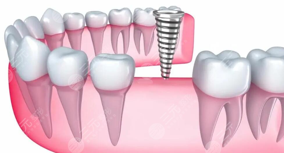 陆军总医院牙科种植牙齿案例分享