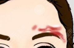 祛疤痕好的方法目前有效的3种医美介绍！美肤修复指南~