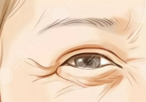 薇旖美可以注射眼部周围的皱纹不？