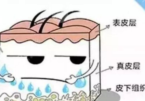 玻尿酸丰胸优缺点