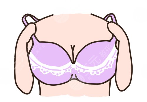 自体隆胸可以保持几年？