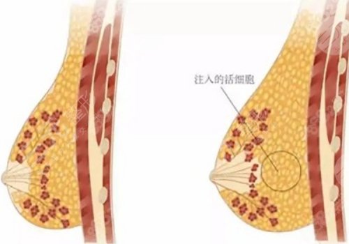 北京张春彦做脂肪丰胸好吗?