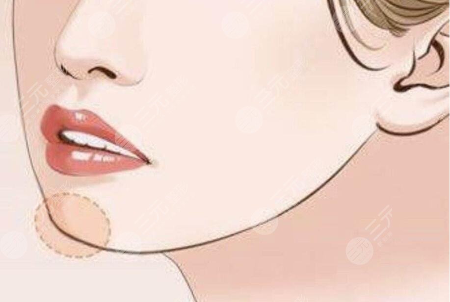 下巴整形要多少钱一针