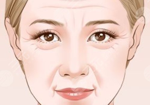 广州陈兵拉皮手术效果如何