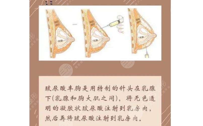 注射玻尿酸丰胸有危险吗?