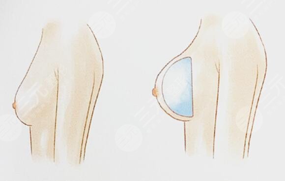 乳房整形效果怎么样