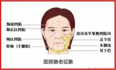 皮肤松弛做拉皮手术怎么样?除皱术前科普,价格参考! 皮肤松弛做拉皮手术怎么样?除皱术前科普,价格参考!
