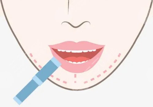 下巴后缩矫正多少钱