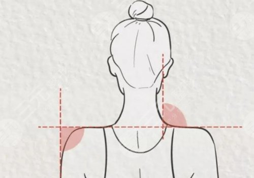 做直角肩多少钱?