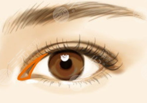 杭州陈海华双眼皮修复